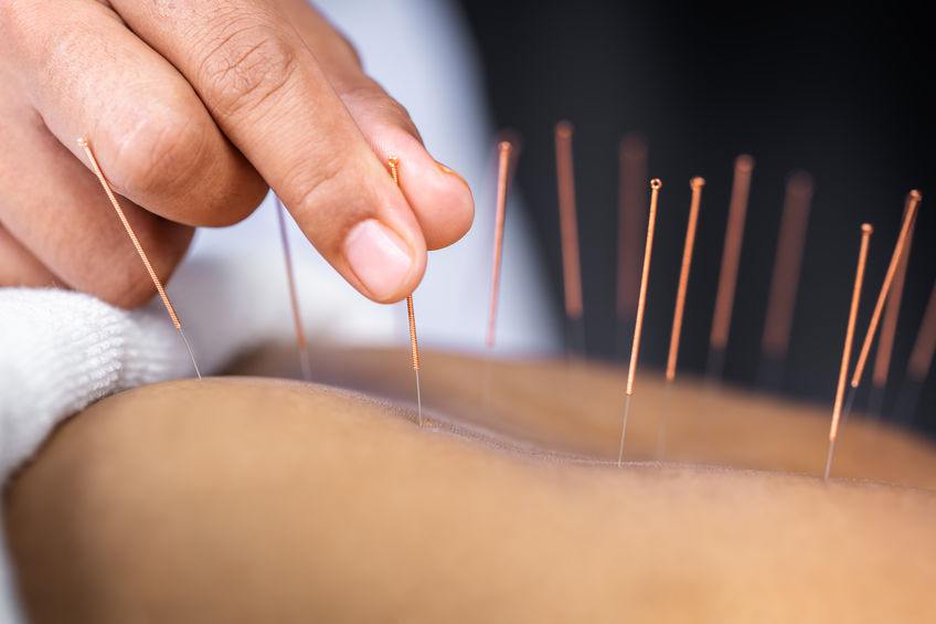 Ultimate Guide To Acupuncture Benefits & Techniques