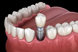 Essential Tips For Successful Implant Dentistry Guide